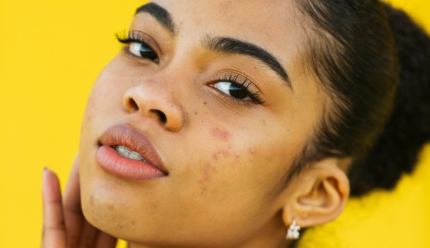 Acne Treatments Cost Americans $1.2 Billion Every Year—Here Are the Ones That Actually Work so...