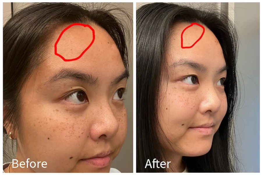 De linkerkant toont de resultaten vóór de behandeling van acne, de rechterkant toont de resultaten na de behandeling van cystic acne
