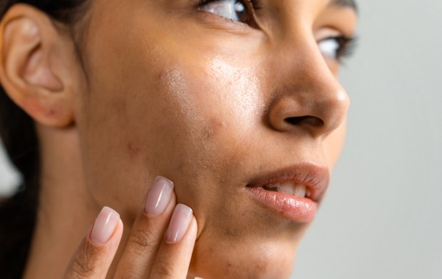 The Truth About Natural Remedies for Acne Scars, According to Dermatologists