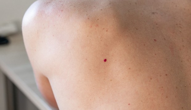 Older Than 30? You Might Start Noticing These Moles on Your Skin
