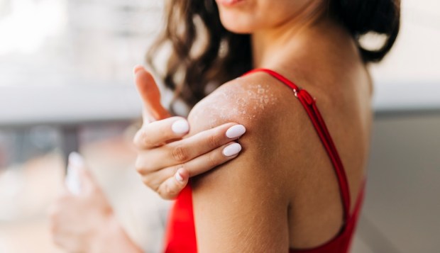 Both Heat Rash and Sun Poisoning Can Cause Blisters, but They're *Not* the Same Thing—Here's...