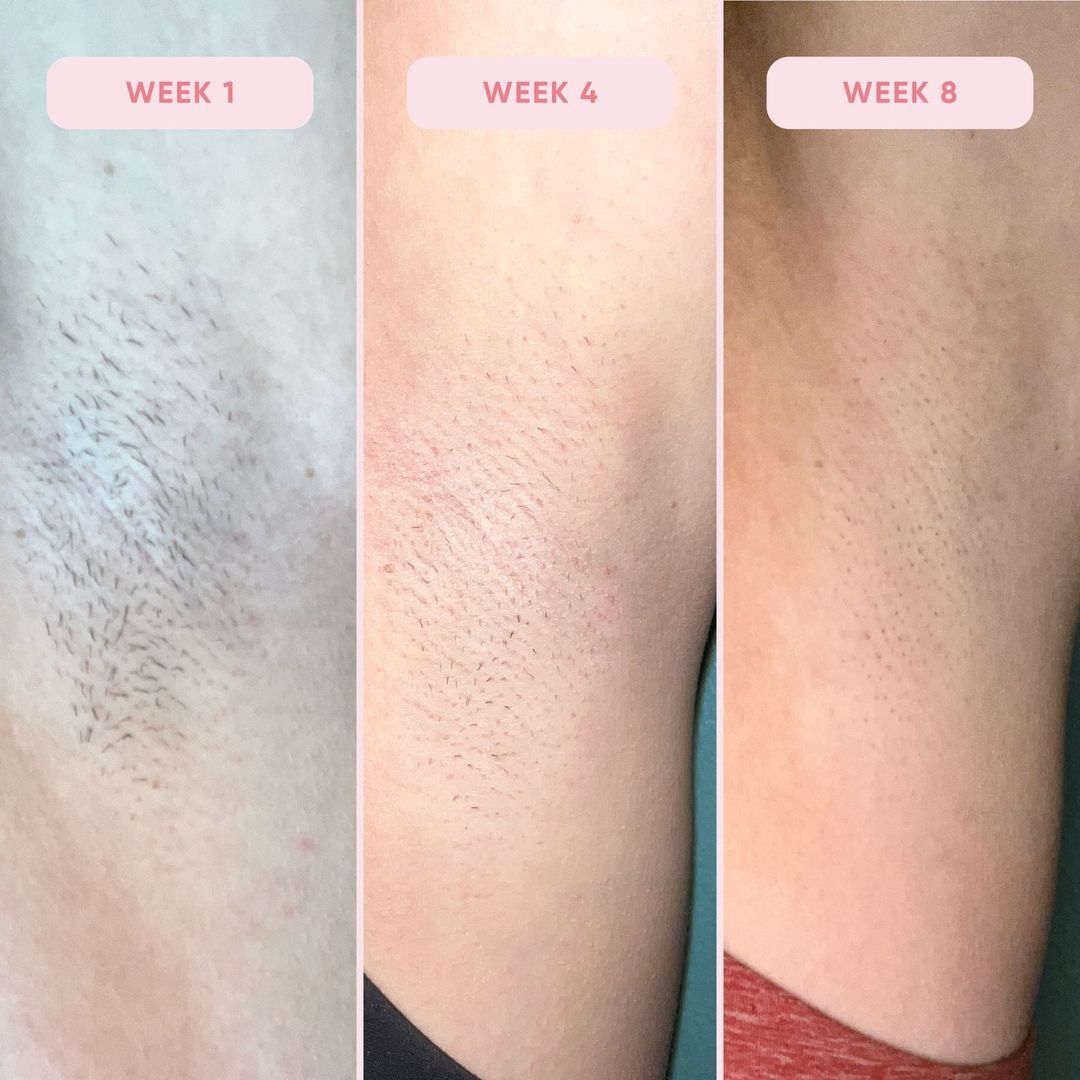 Weekly progressions of hair reduction after using the Rose Skin Co Lumi hair removal device