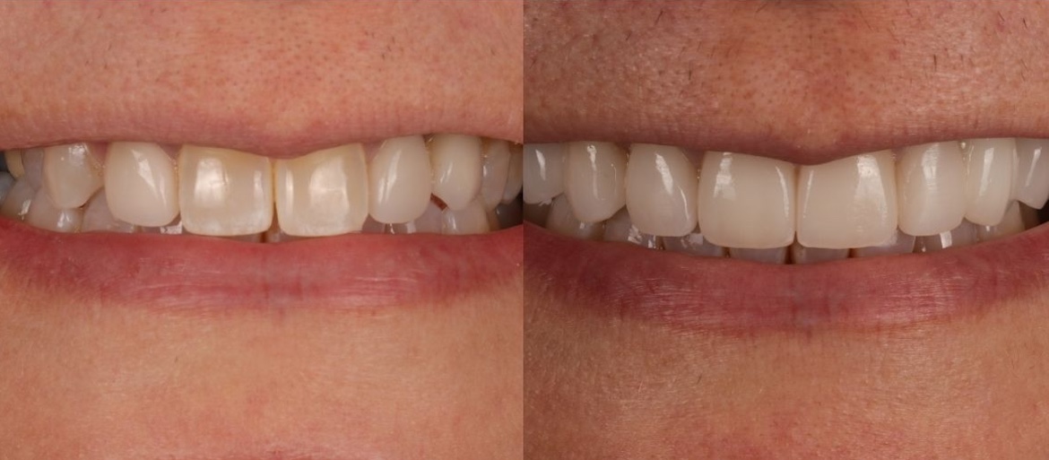 before and after photo of veneers